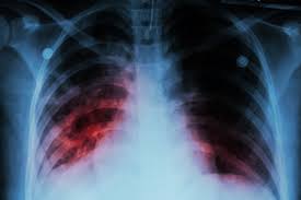 Pulmonary Infections